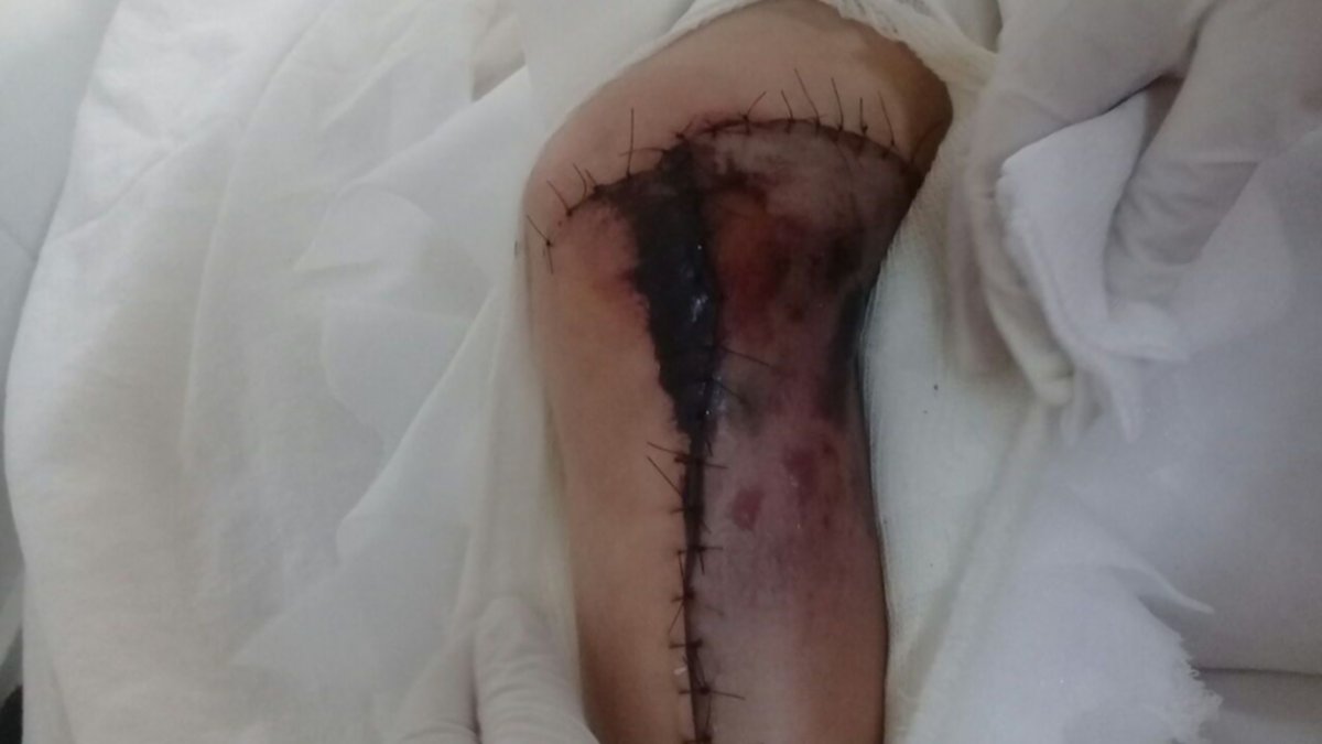 Nena de 7 años casi pierde una pierna por una columna de hormigón