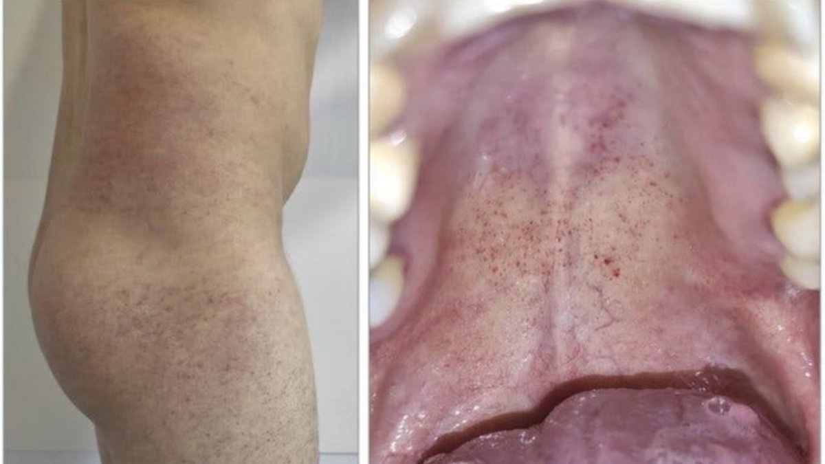 Alertaron sobre un nuevo síntoma de Coronavirus