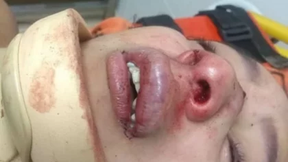 La chica desfigurada era hostigada desde hace tiempo
