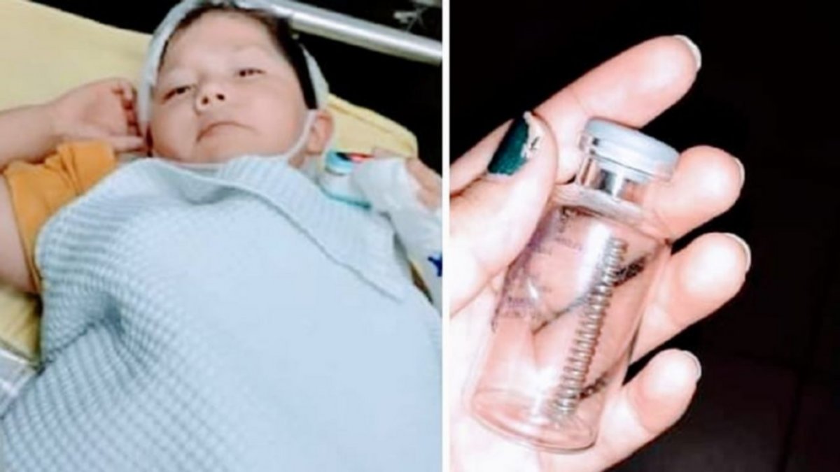 Le extrajeron un resorte del pulmón a un niño de 6 años