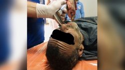 Llegó a la guardia asfixiado: ¡tenía un pez vivo en la garganta!