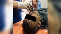 Llegó a la guardia asfixiado: ¡tenía un pez vivo en la garganta!