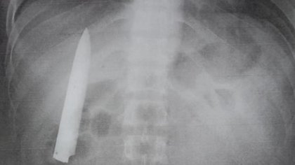 Llevó una hoja de cuchillo en su torso ¡14 meses!
