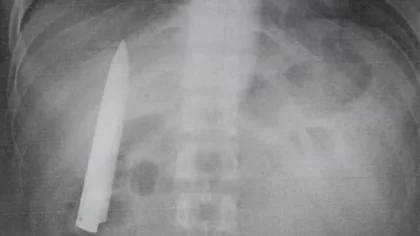 Llevó una hoja de cuchillo en su torso ¡14 meses!