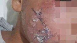 Un pitbull le destrozó la cara a un nene de 9 años