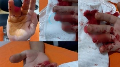 Así quedó el dedo de un recolector de 21 años