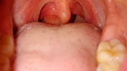 ¿Qué es la odinofagia?: alarmante nuevo síntoma de ómicron