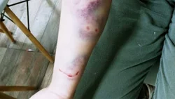 Dos pitbull mataron una costosa perra e hirieron a su dueña