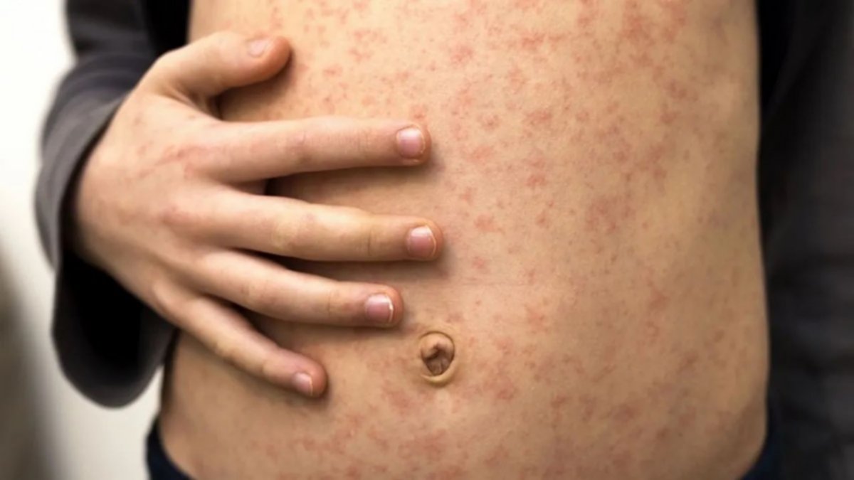 Se confirmaron 7 nuevos casos de viruela del mono en el país