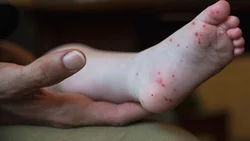 ¿De qué se trata el virus que afecta a niños de Neuquén?