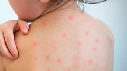 Alerta sarampión: afecta a niños y se confirmó un caso en el país