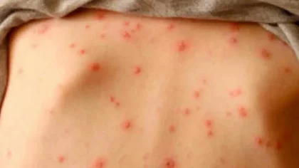 Qué hacer ante la alerta por sarampión