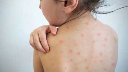 Epidemiología dio datos sobre el caso sospechoso de sarampión en Loncopué