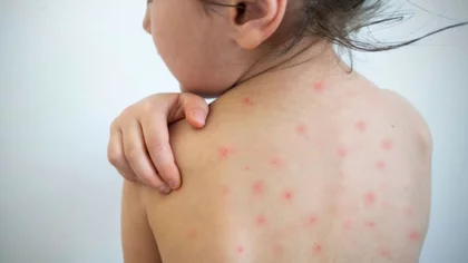 Epidemiología dio datos sobre el caso sospechoso de sarampión en Loncopué