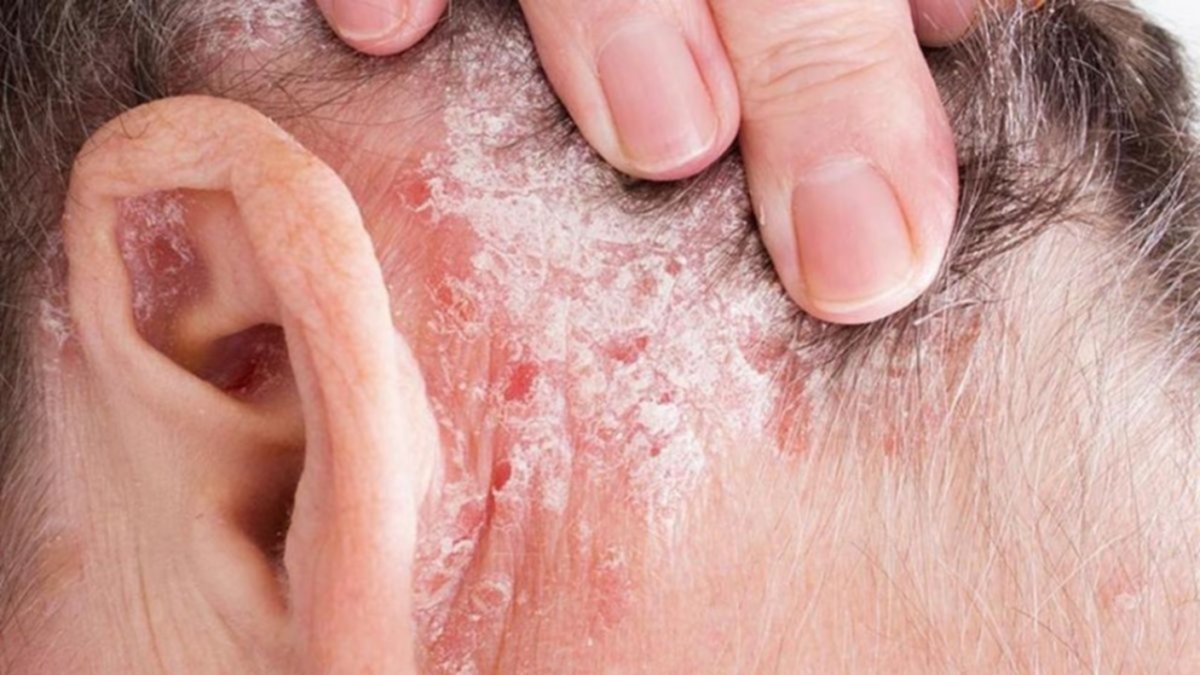 Lanzan campaña de detección de psoriasis y artritis psoriásica en Neuquén